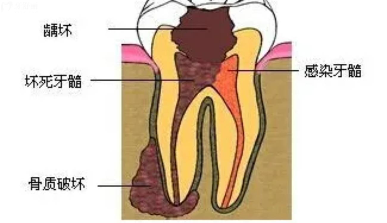 牙髓炎的临床症状和防治原则.jpg