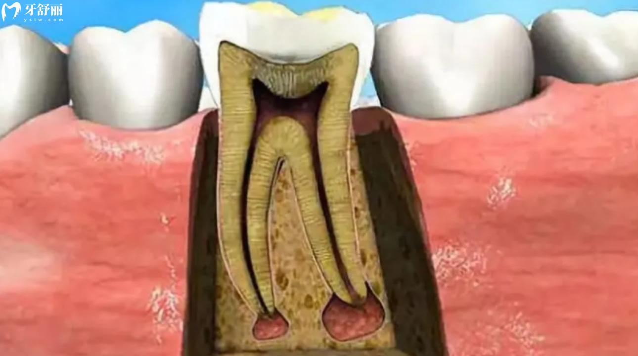 急性牙髓炎在家怎么缓解疼痛?如何判断牙髓炎?