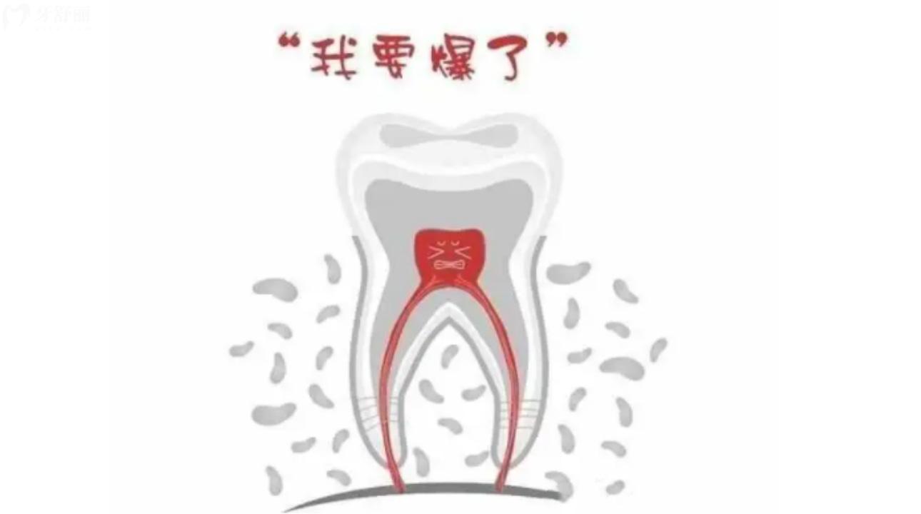 急性牙髓炎在家怎么缓解疼痛?如何判断牙髓炎?