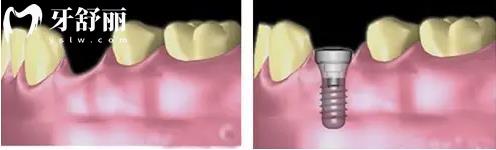牙列缺损常用的修复方法是什么？整理三种镶牙优缺点