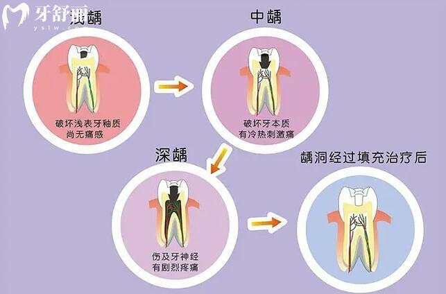 牙髓炎会自愈吗