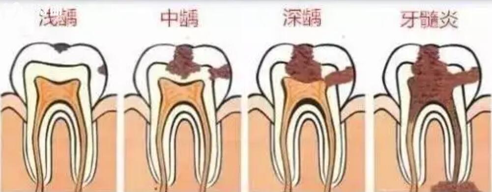 牙髓炎会自愈吗