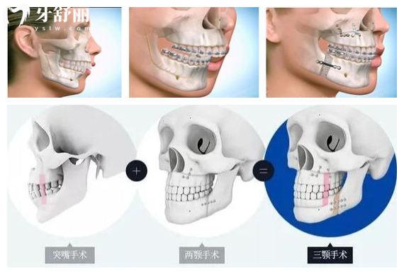 骨性凸嘴正颌手术费用大概需要多少 国内做正颌手术哪家医院靠谱