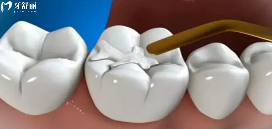 补牙多少钱一颗牙需要多久？什么情况的牙齿需要补