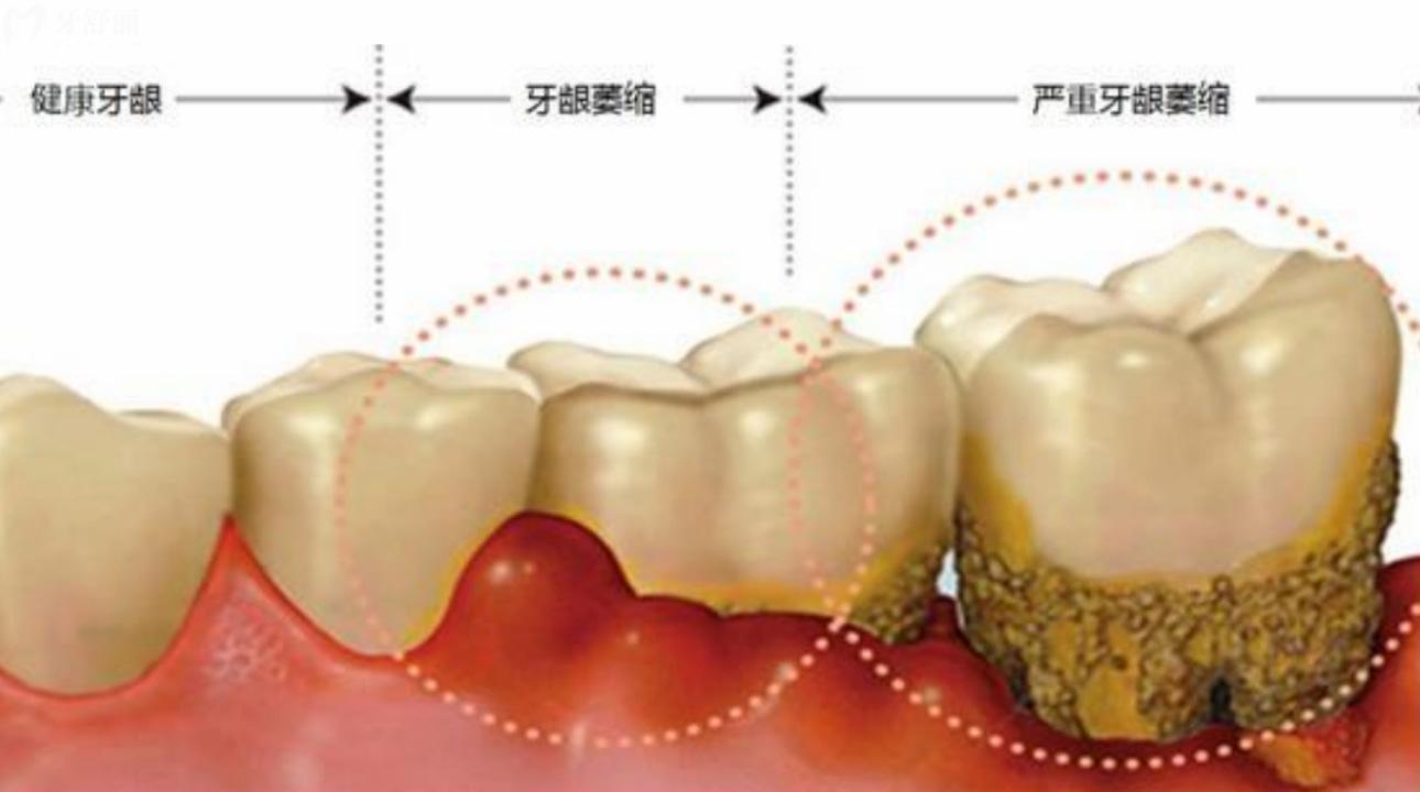 牙龈萎缩恢复手术价位了解下!牙龈萎缩能恢复吗?