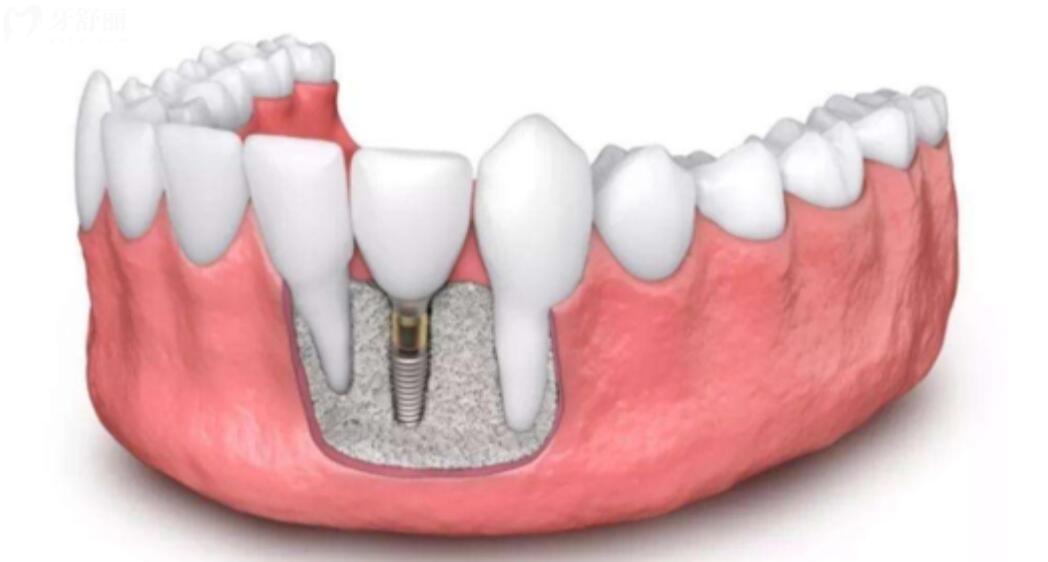 镶牙齿与种植牙的区别