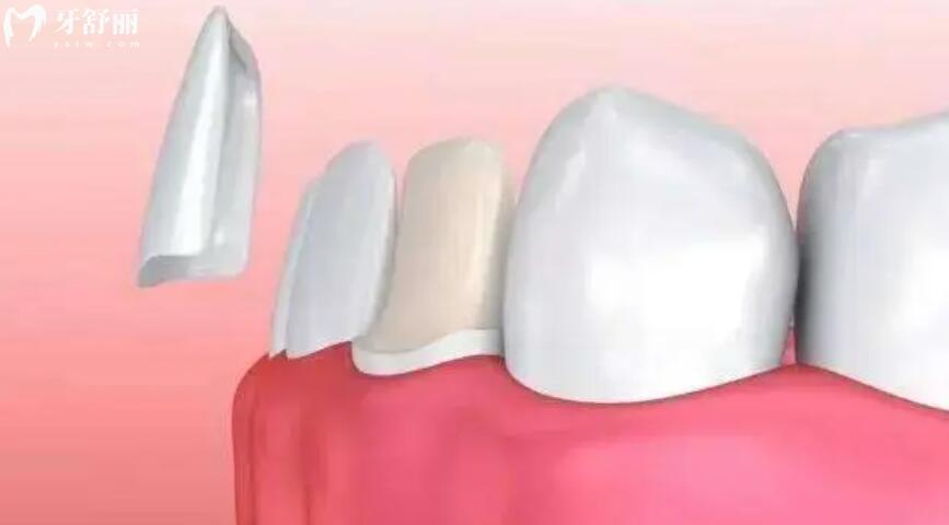 牙贴面是怎么做的过程分享