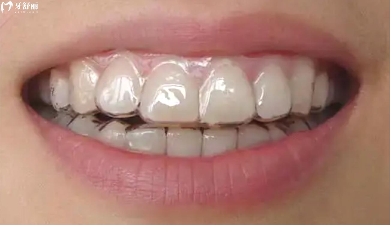 隐形牙套是怎么矫正牙齿的.jpg