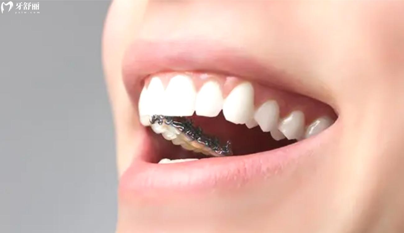 隐形牙套是怎么矫正牙齿的.jpg