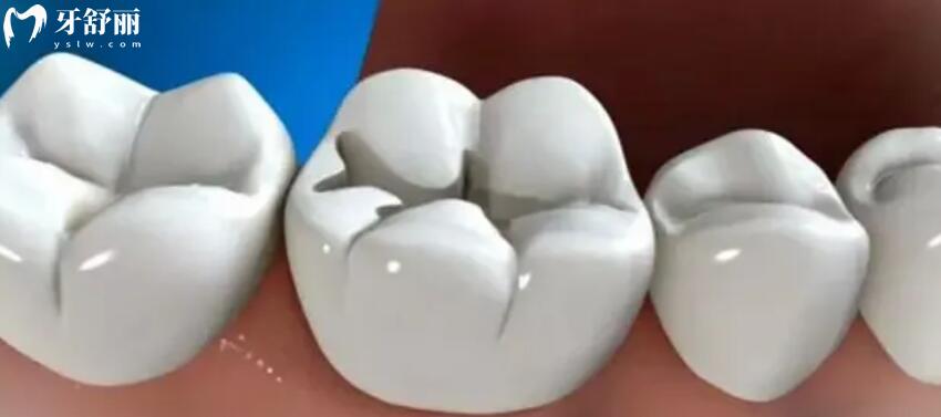 补牙多少钱一颗牙树脂材料