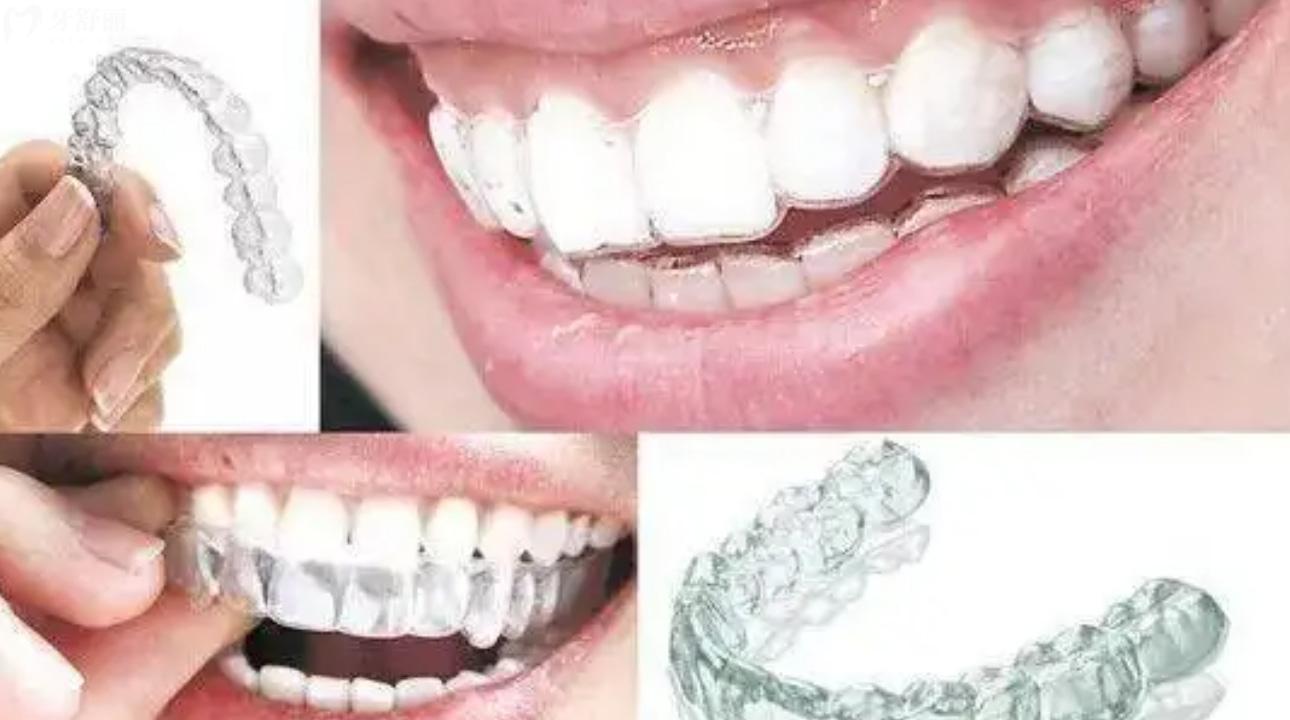 西安镶牙好的医院并公布种植牙多少钱一颗?含种牙正畸!