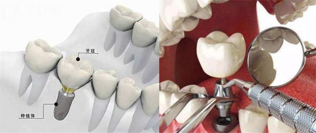 传统种植牙和即刻用哪个好 分析种牙方式价格和优缺点
