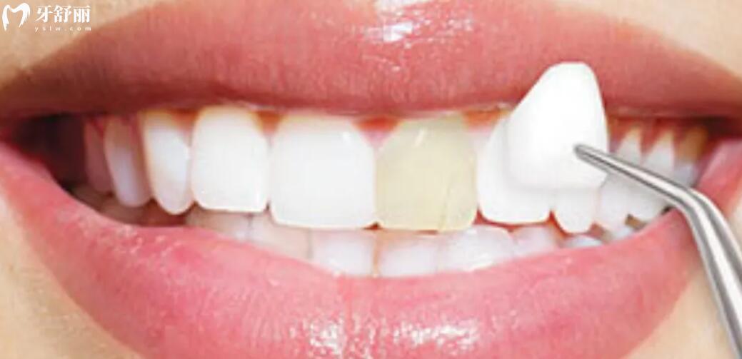 牙齿贴面和烤瓷牙的区别