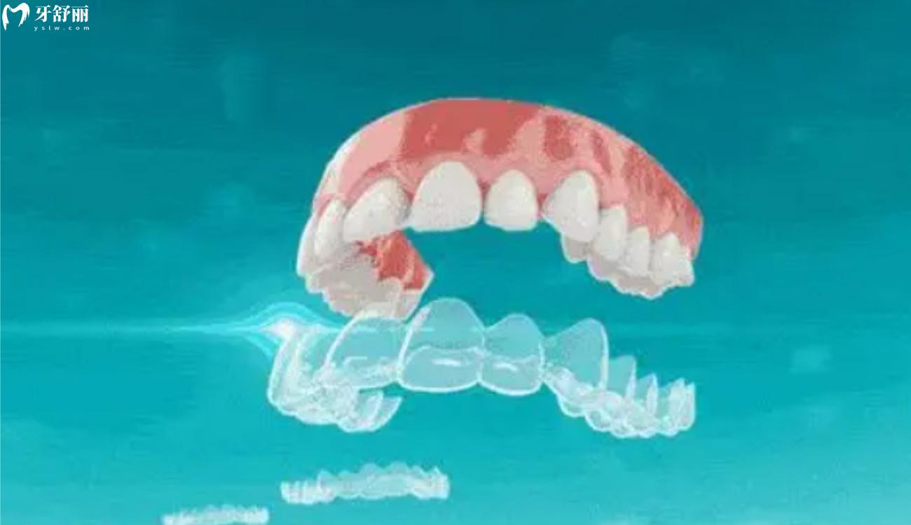 缺牙能做牙齿矫正吗.jpg