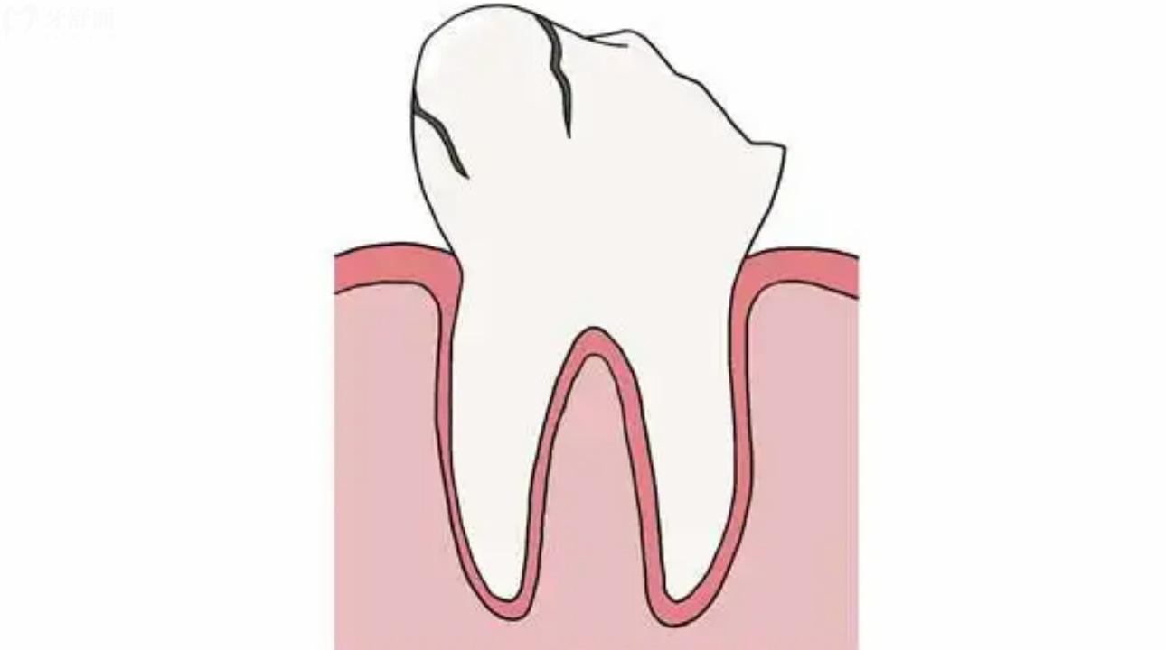 根管治疗后牙齿劈裂了 根管治疗后牙齿又坏了怎么办？