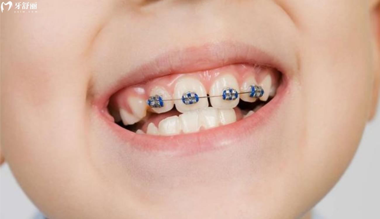 儿童牙齿早期干预矫正有必要吗.jpg