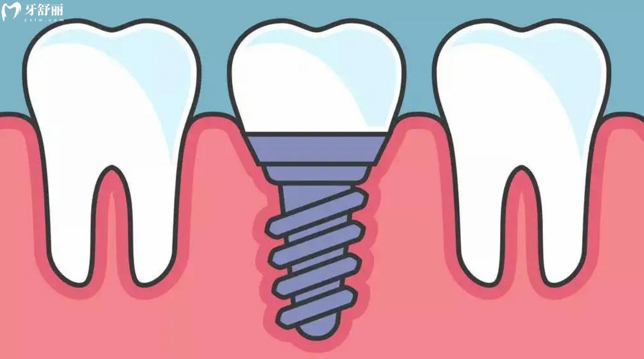 种植牙一期二期三期流程及时间详解 一期到二期时间多久?