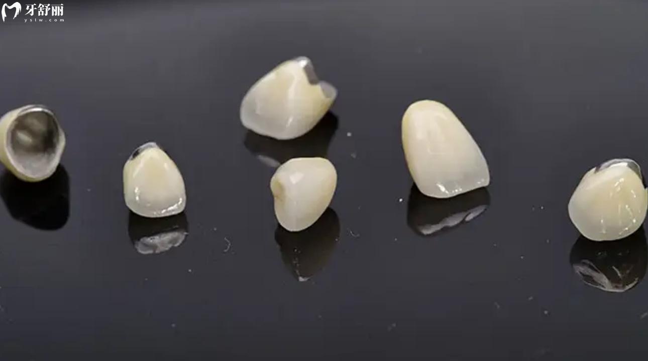 烤瓷牙300的牙和500的牙区别?烤瓷牙材料有哪些?