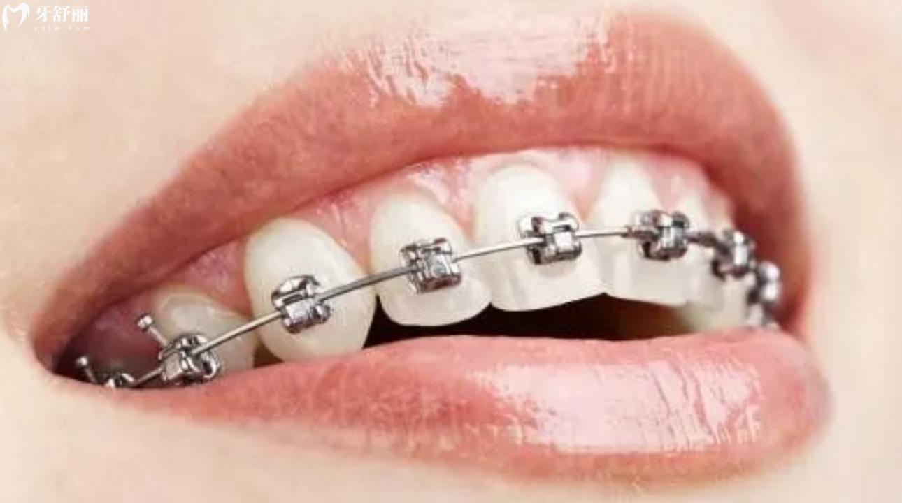 揭秘佛山禅医口腔医院价目表 种牙/矫牙都不贵