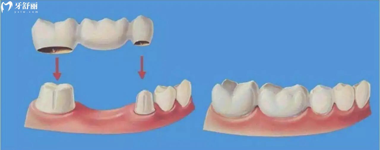 固定义齿能用多长时间?固定义齿安装过程和优缺点都有哦