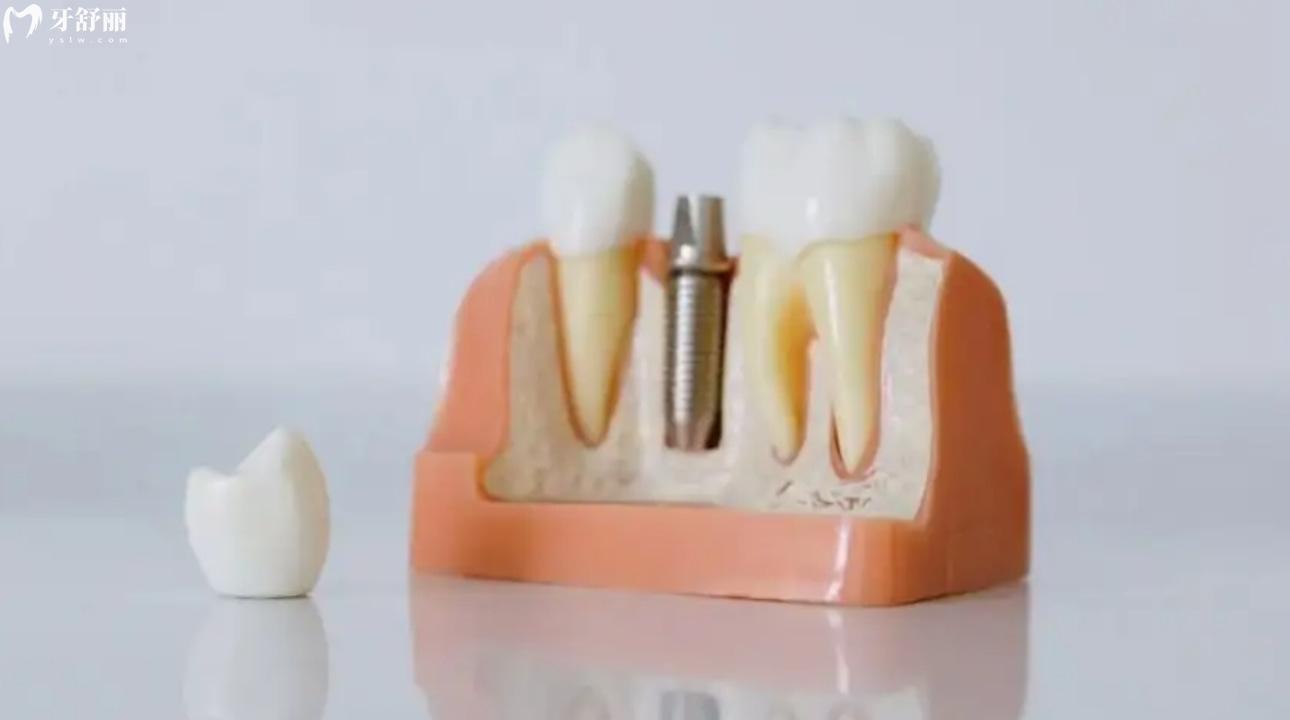 瑞士士卓曼种植牙能用多久啊?牙齿种植体类型有哪些?