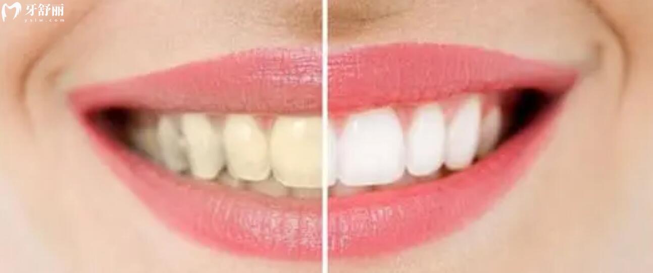 激光美白牙齿和冷光美白哪个好一点？应该怎么选择？