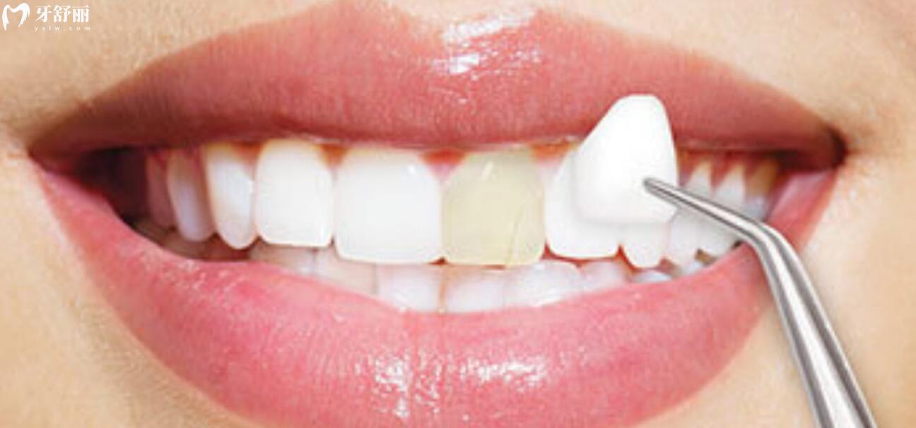为什么医生不建议做牙齿贴面呢?有知道的吗？