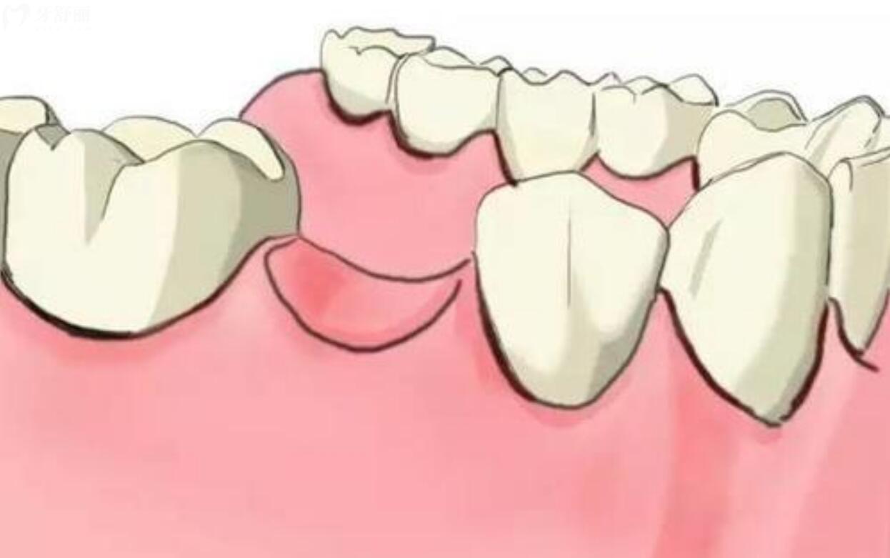 后两颗牙缺失如何修复图片？缺牙的3种修复方式分享