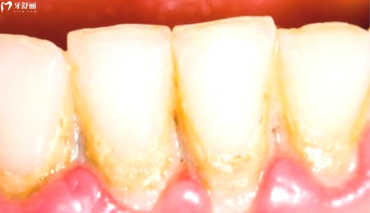 牙缝中间黄黄的是什么.jpg