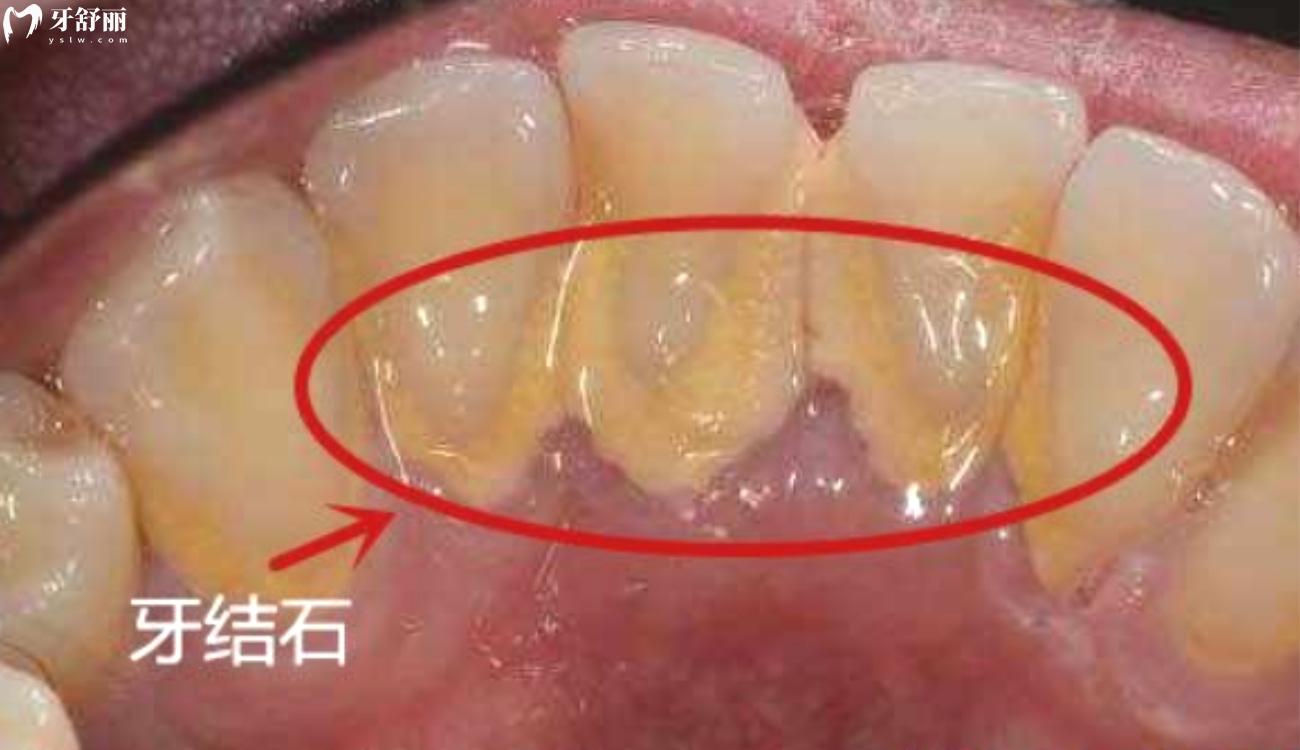 牙缝中间黄黄的是什么.jpg