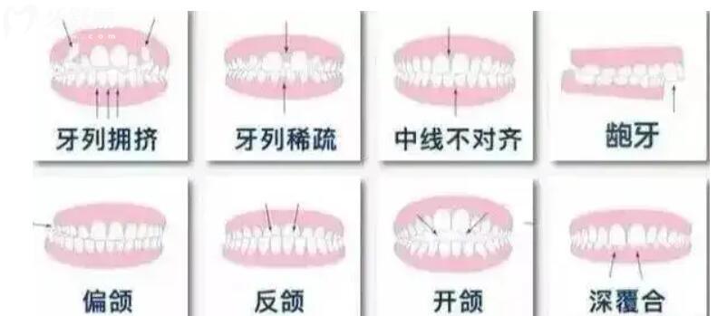 做牙齿矫正有年龄限制吗 做牙齿矫正有年龄限制吗