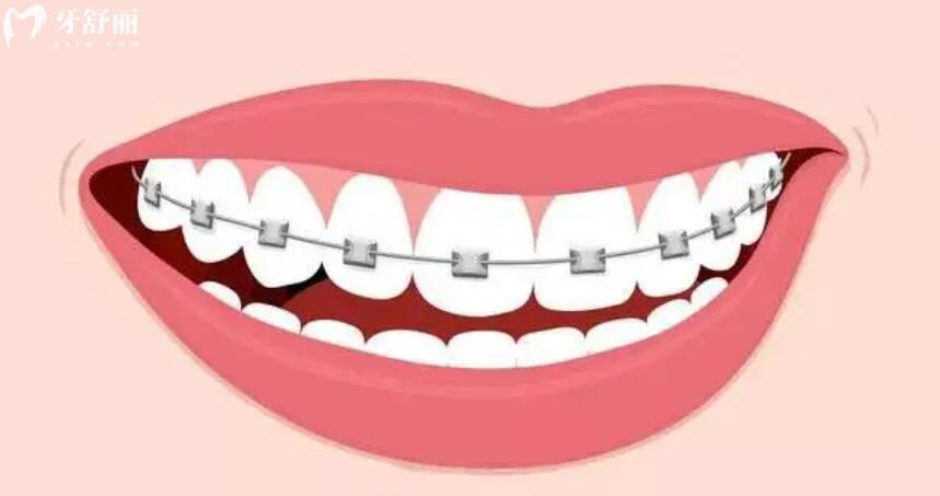 做牙齿矫正有年龄限制吗 做牙齿矫正有年龄限制吗