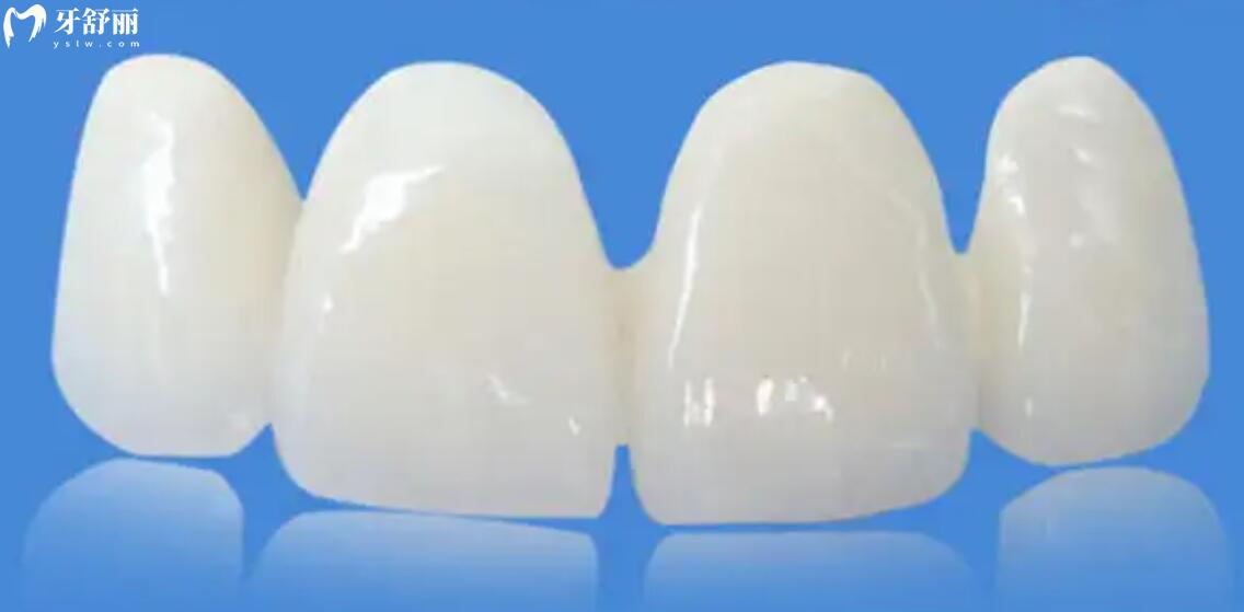 做牙冠树脂的好还是全瓷的好 做牙冠树脂的好还是全瓷的好