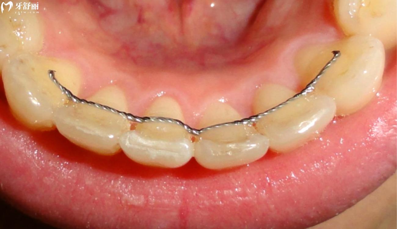 保持器一 天不戴就紧紧的是什么原因.jpg 保持器一 天不戴就紧紧的是什么原因.jpg