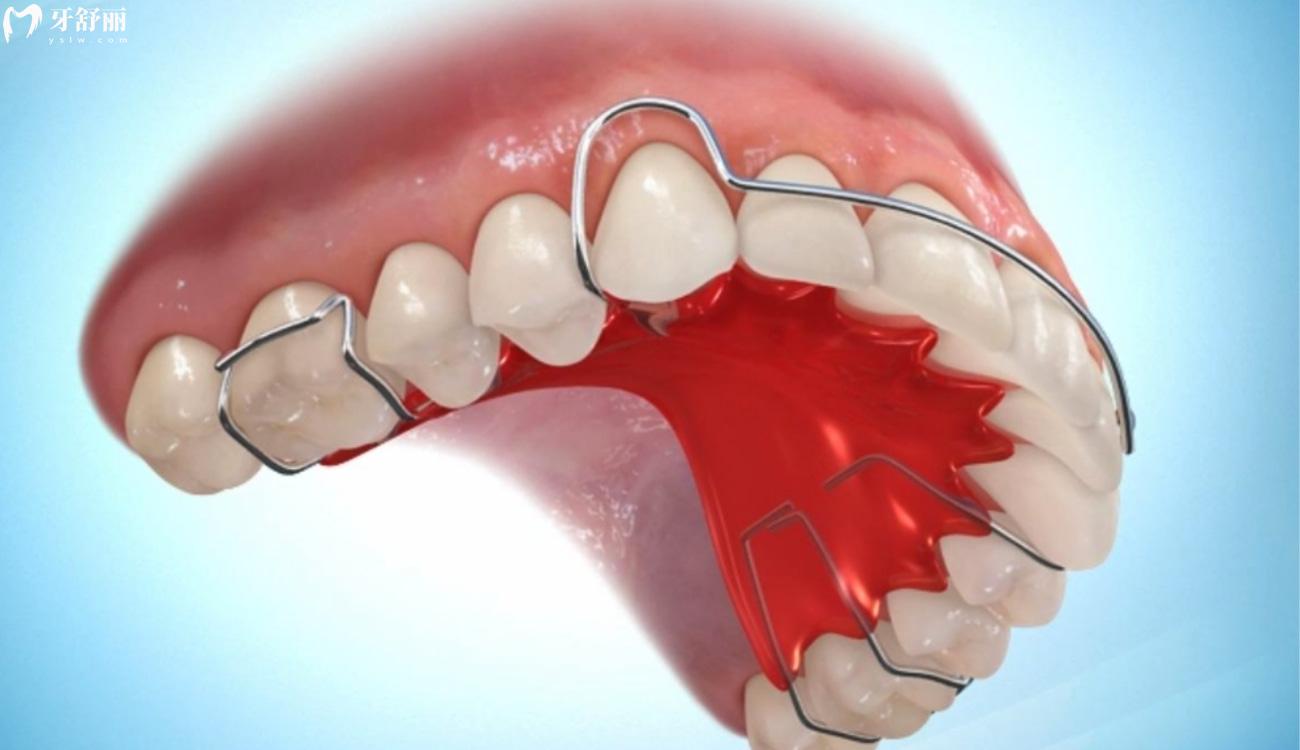 保持器一 天不戴就紧紧的是什么原因.jpg 保持器一 天不戴就紧紧的是什么原因.jpg