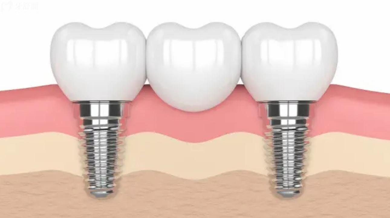瑞士iti种植牙质保几年?瑞士ITI种植牙型号有哪些呢? 瑞士iti种植牙质保几年?瑞士ITI种植牙型号有哪些呢?