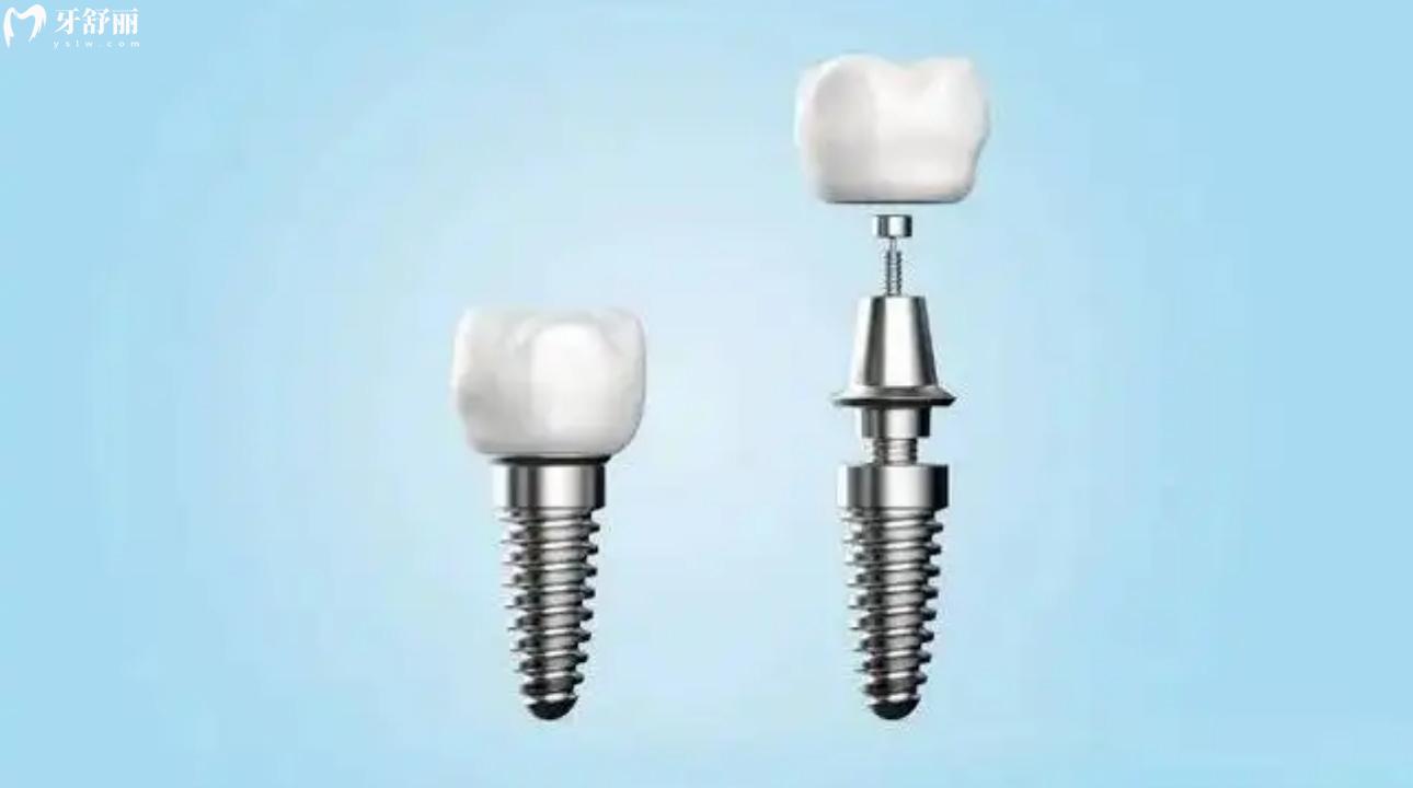 瑞士iti种植牙质保几年?瑞士ITI种植牙型号有哪些呢? 瑞士iti种植牙质保几年?瑞士ITI种植牙型号有哪些呢?