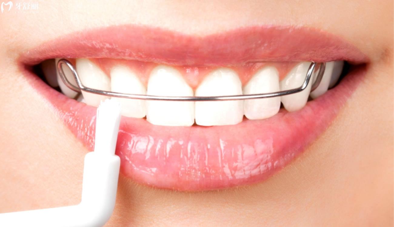 正畸后反弹的几率有多大.jpg 正畸后反弹的几率有多大.jpg