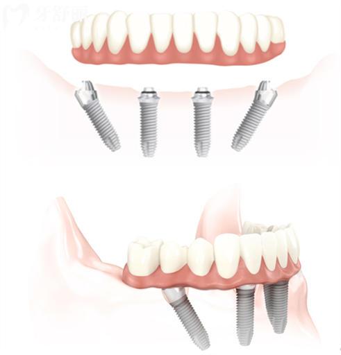 新型种植技术是不是智商税?盘点有哪些靠谱种植牙手术 新型种植技术是不是智商税?盘点有哪些靠谱种植牙手术