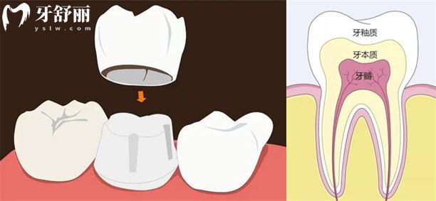 为什么不建议做烤瓷牙?金属烤瓷牙必须要知道的缺陷 为什么不建议做烤瓷牙?金属烤瓷牙必须要知道的缺陷