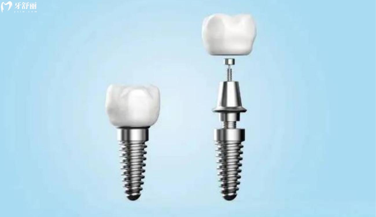 种植牙齿什么品牌比较好.jpg 种植牙齿什么品牌比较好.jpg