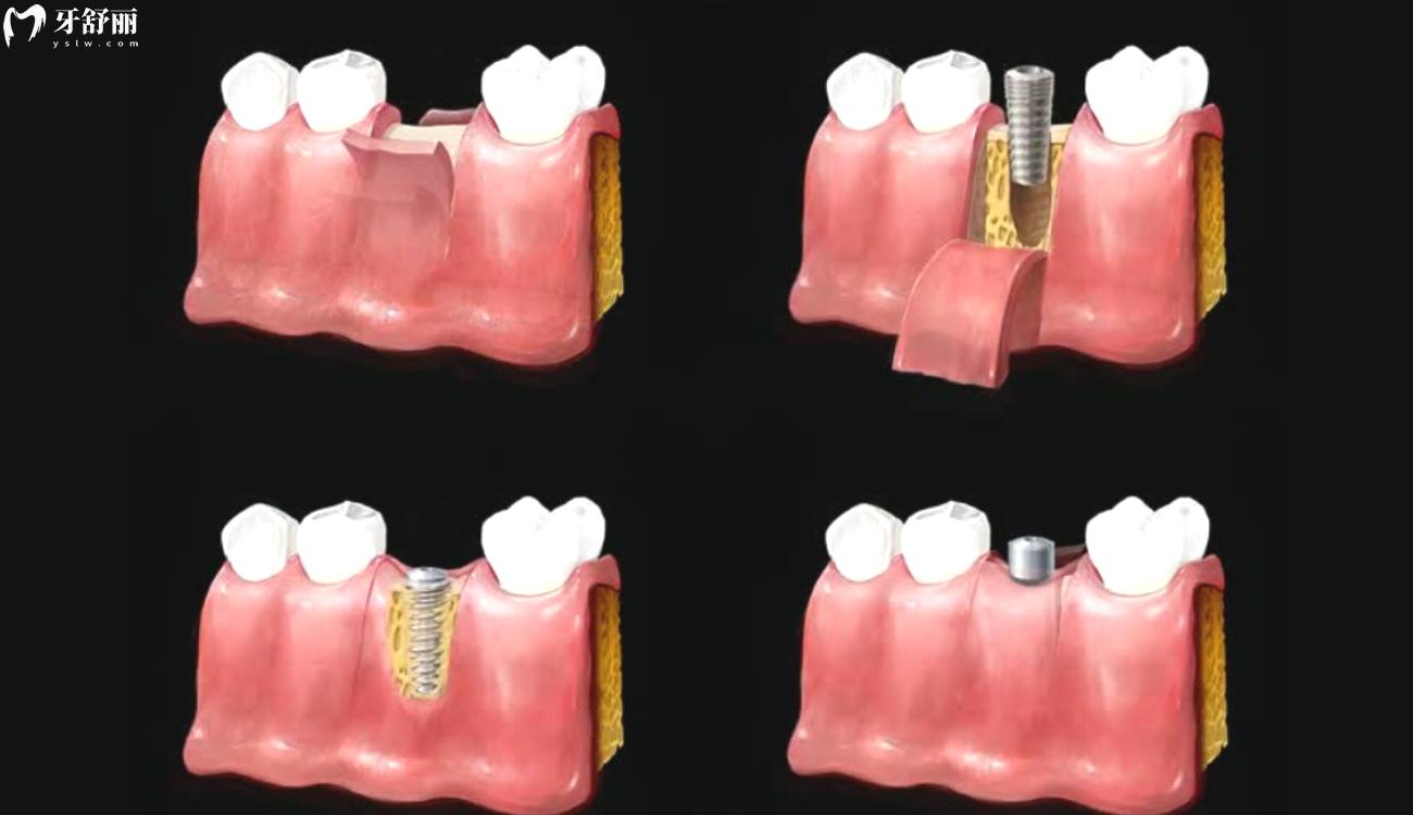 种植牙多少钱一颗.jpg 种植牙多少钱一颗.jpg