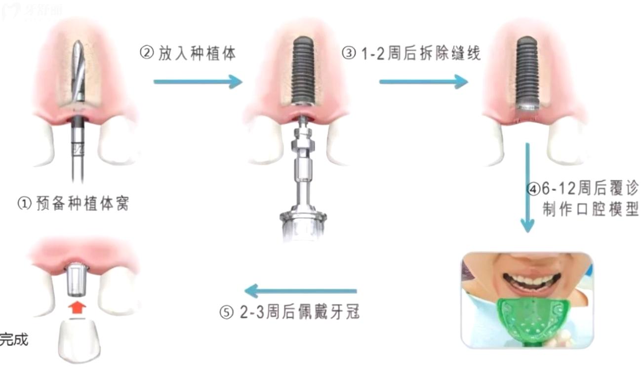种植牙多少钱一颗.jpg 种植牙多少钱一颗.jpg