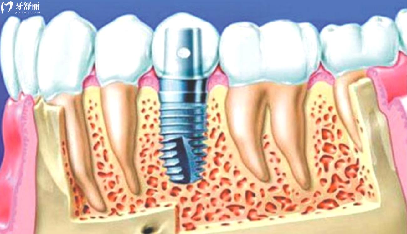种植牙多少钱一颗.jpg 种植牙多少钱一颗.jpg
