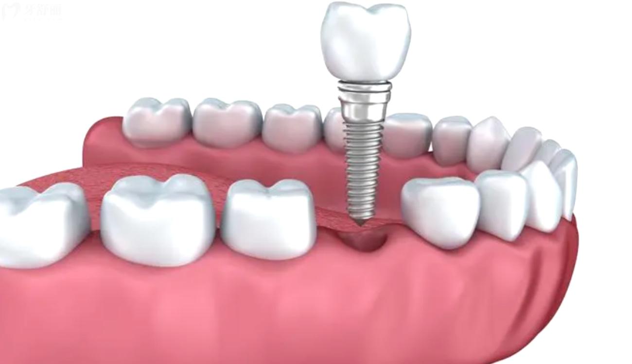 种植牙多少钱一颗.jpg 种植牙多少钱一颗.jpg