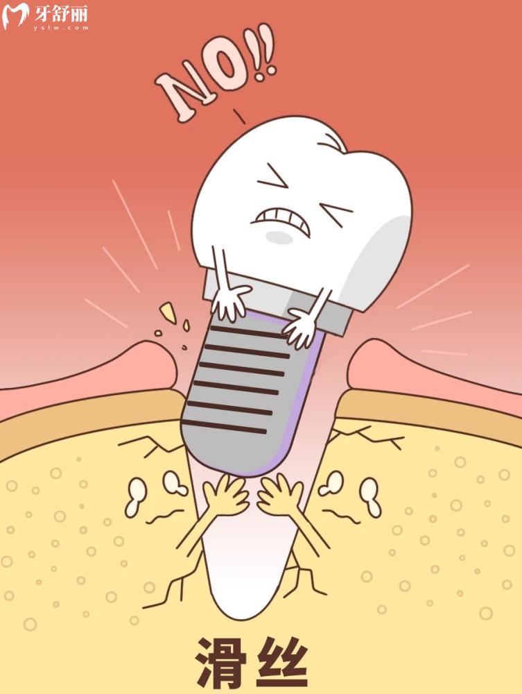 不注意护理,将近2W的种植牙失败了后悔一辈子 不注意护理,将近2W的种植牙失败了后悔一辈子