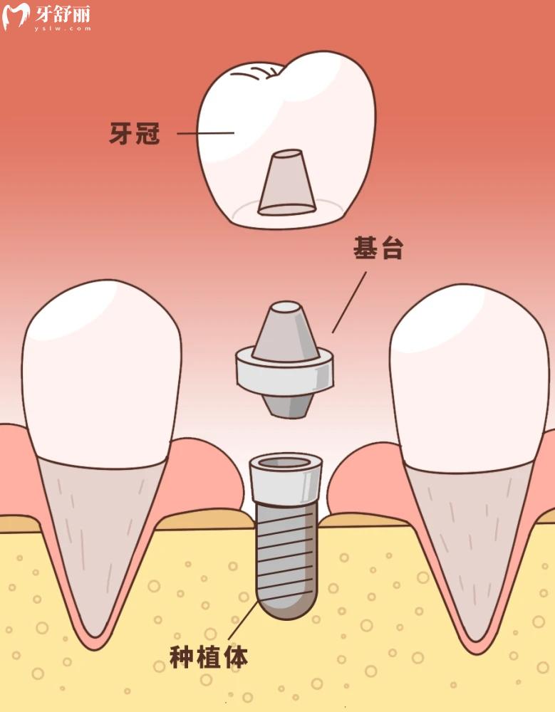 不注意护理,将近2W的种植牙失败了后悔一辈子 不注意护理,将近2W的种植牙失败了后悔一辈子