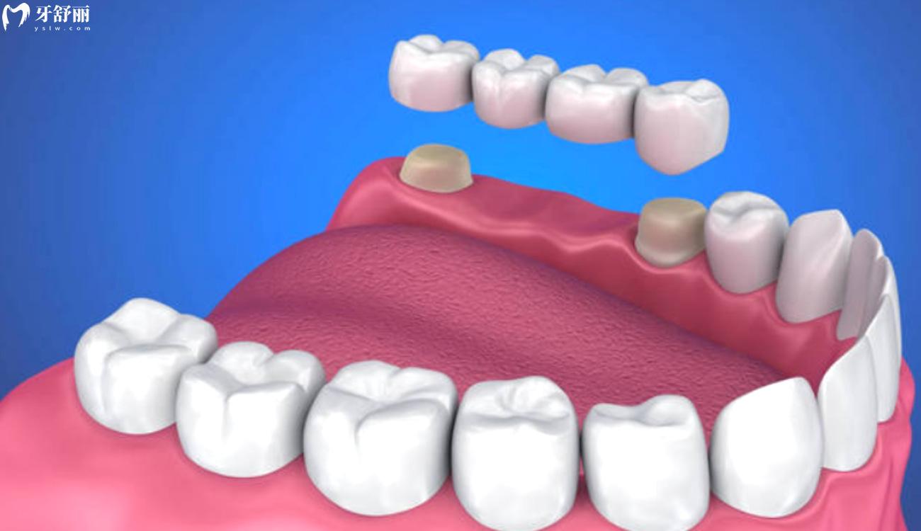 义齿和种植牙的区别.jpg