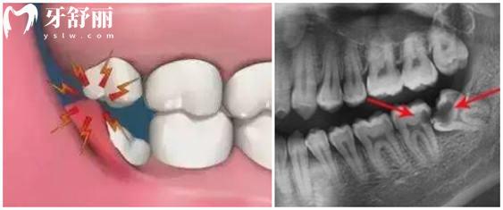 牙齿矫正必须要拔牙吗?拔掉四颗牙对以后生活影响 牙齿矫正必须要拔牙吗?拔掉四颗牙对以后生活影响