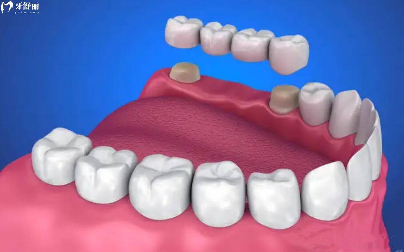 老人里面的牙齿都掉了,怎么办?如果不管会有危害吗? 老人里面的牙齿都掉了,怎么办?如果不管会有危害吗?